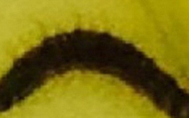 Woman Urinates Worms For Three Months