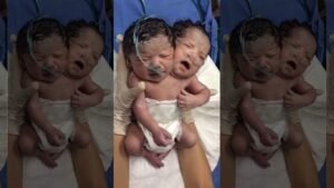 Two-Headed Baby Born In Mexico