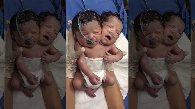Two-Headed Baby Born In Mexico