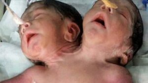 Healthy 2-Headed Baby Born, But Disaster Strikes After Parents Refuse To Listen To Doctor