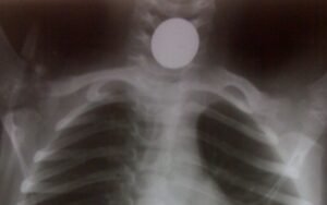 Mother Sees Daughter Choking, Horrified By What It Is (Photos)