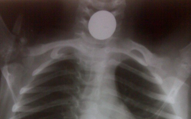 Mother Sees Daughter Choking, Horrified By What It Is (Photos)