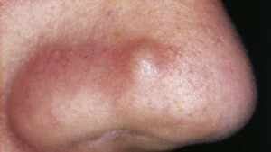 Loving Wife Decides To Pop Husbands Lump -- Is Shocked By What Comes Out