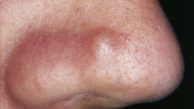 Loving Wife Decides To Pop Husbands Lump -- Is Shocked By What Comes Out