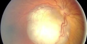 Doctors Finally Figure Out What's Wrong With Baby's Eyes (Photos)