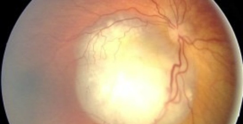 Doctors Finally Figure Out What's Wrong With Baby's Eyes (Photos)