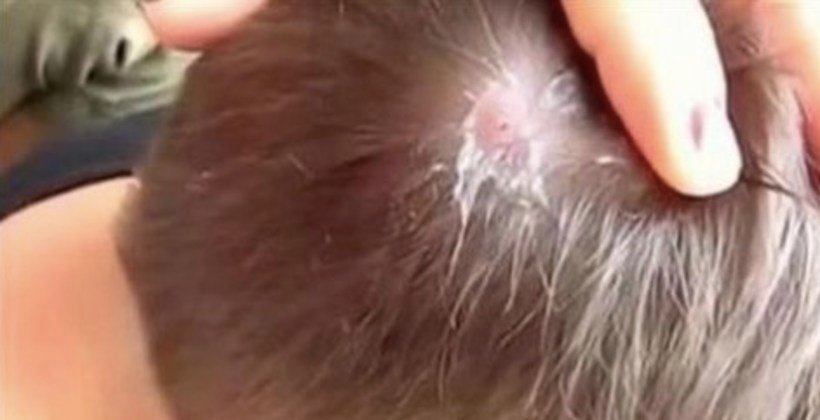 Man Goes On Overseas Trip And Feels Strange Bump On Head, Reaches In And Pulls Out... (Video)