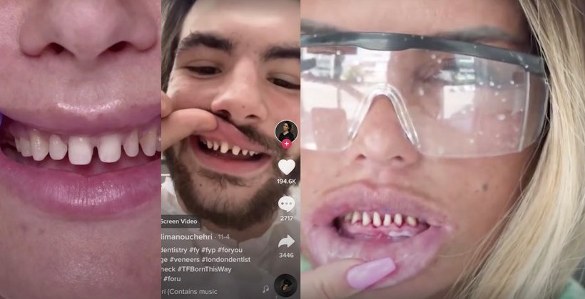 Dentists Warn Against Dangerous New Influencer Trend On Social Media